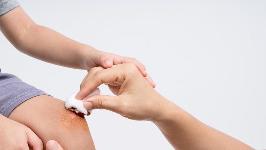 Ilustrasi Perawatan Luka pada Anak