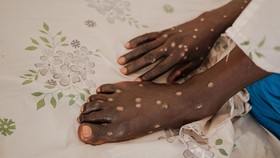 Kasus Pertama Varian Lebih Mematikan Mpox Terdeteksi di AS