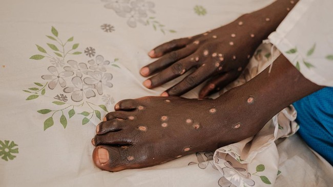 CDC melaporkan satu pasien terdeteksi mpox clade I di California, yang merupakan pertama di Amerika Serikat.