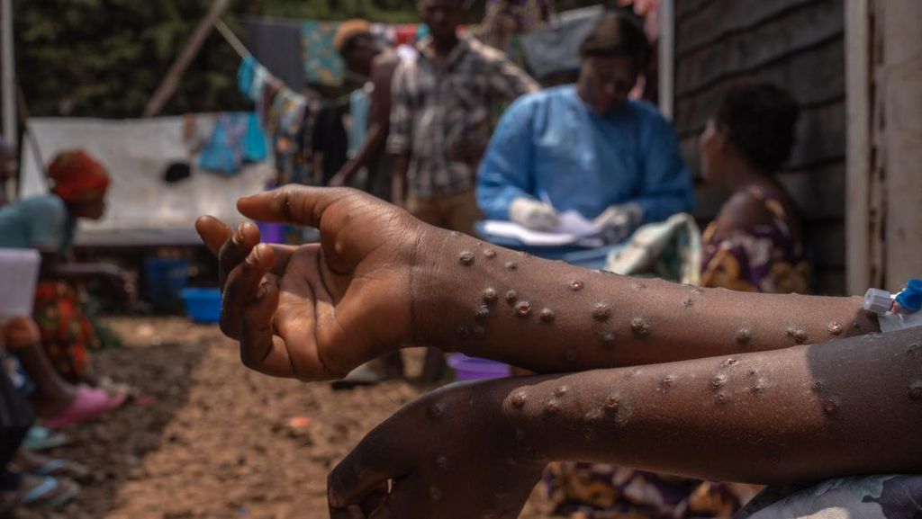 Status Darurat Mpox Dicabut, Afrika Masuki Fase Eliminasi