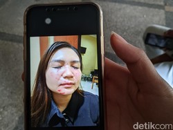 Selebgram Dwita Qorina Diduga Dianiaya Mantan Suami Siri hingga Babak Belur