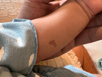 Penyebab Tanda Lahir Bayi Berbentuk Hati Seperti Dimiliki Anak Joshua Suherman