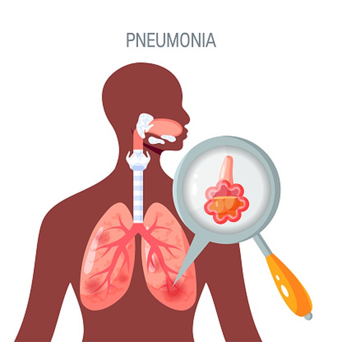Ilustrasi paru-paru basah atau pneumonia.