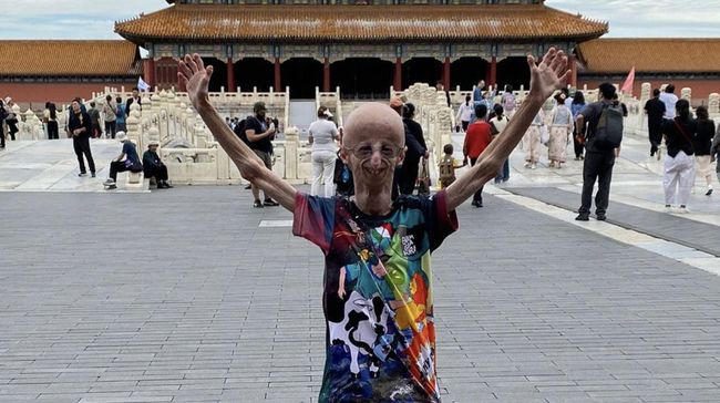 Sammy Basso, penyintas terlama progeria, meninggal dunia pada Minggu (6/10). Progreria merupakan penyakit langka yang membuat penderitanya menua dengan cepat.
