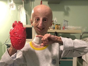 Sosok Sammy Basso Penyintas Genetik Langka Progeria yang Meninggal Dunia