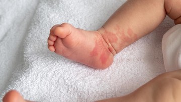 Penyebab bayi memiliki tanda lahir bentuk hati