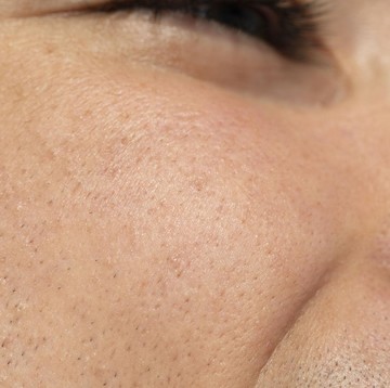 4 Cara Mengatasi Pori-pori Besar di Wajah Menurut Ahli