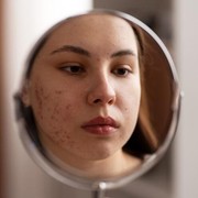 Benarkah Konsumsi Telur Dapat Memicu Tumbuhnya Jerawat? Cek Penjelasannya!