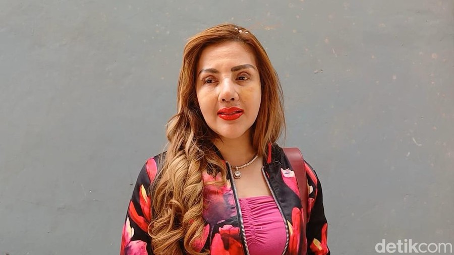 Barbie Kumalasari usai operasi plastik&period;