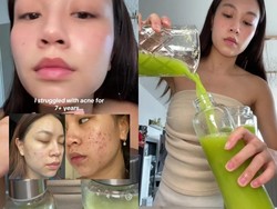 Racikan Jus Seledri dan Nanas Bisa Sembuhkan Jerawat