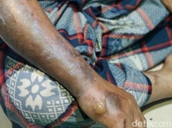 Marbot di Pekalongan Disiram Air Keras OTK, Polisi Turun Tangan