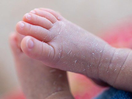 Mengenal Harlequin Ichthyosis, Kelainan pada Kulit Bayi Sejak Lahir