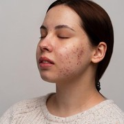 Menurut Para Ahli, Ini Perbedaan Purging dan Breakout saat Pemakaian Skincare