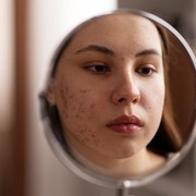 3 Cara Mudah Mengetahui Skincare Milikmu Cocok atau Tidak untuk Sembuhkan Jerawat, Cek!