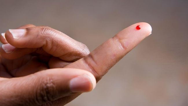 Seorang wanita 21 tahun mengalami pendarahan dari wajah dan telapak tangan tanpa luka. Dokter mendiagnosisnya dengan hematohidrosis.
