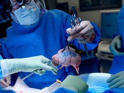 Daftar Manusia Penerima Donor Organ Babi, Ada yang Cuma Bertahan 2 Bulan