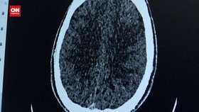 VIDEO: Peneliti Ciptakan AI untuk Diagnosis Stroke Lebih Cepat