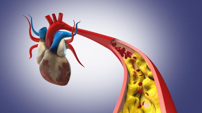 Penyakit jantung membutuhkan layanan medis cepat dan tepat, sekaligus kredibel dan dapat diandalkan seperti di Cardiovascular Center Mayapada Hospital.