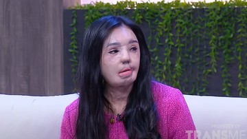 Lisa menjalani operasi plastik sebanyak 18 kali
