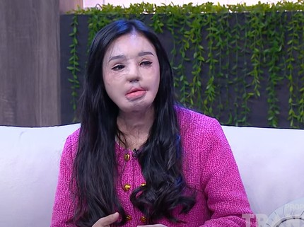 Kisah Pilu Lisa 'Face Off' Disiram Air Keras oleh Suami, Baru Diketahui Keluarga 3 Th Usai Kejadian