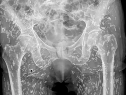 Ciri-ciri Cacing Pita Bersarang di Tubuh, Ada yang Ketahuan Lewat X-Ray