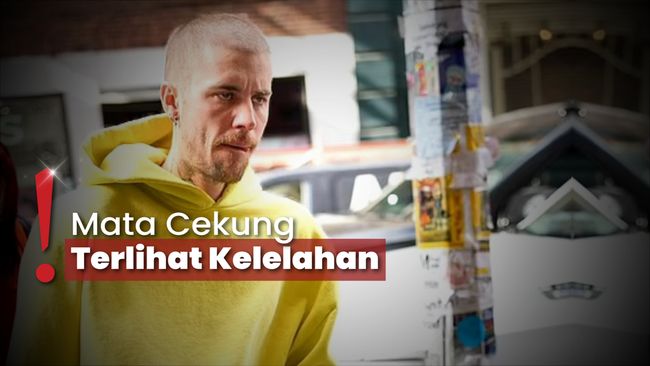 Penampilan Justin Bieber Memprihatinkan, Tubuh Semakin Kurus