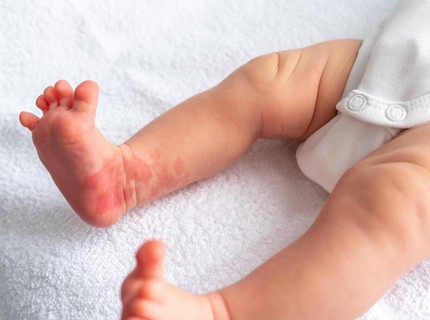Mengenal Hemangioma pada Anak, Tumor Jinak yang Mirip dengan Tanda Lahir
