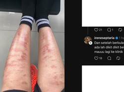 Viral Wanita Jatim Kena Efek Tak Terduga usai IPL Bulu Kaki, Bak Luka Melepuh