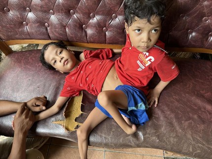 Kembar Siam dengan Perut Menyatu, Syafaat dan Hidayah Tetap Tegar Terima Takdir