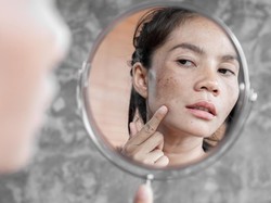 Kulit Merah-merah Pasca Konsumsi Makanan Tertentu? Hati-hati, Bisa Jadi Rosacea