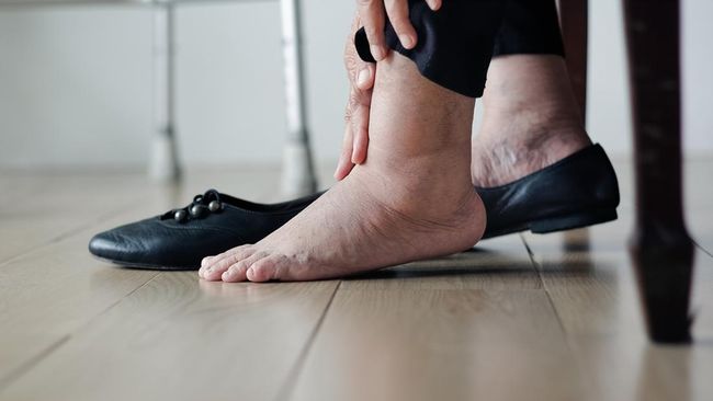 Sering Dianggap Sepele, 4 Kondisi Ini Bisa Jadi Tanda Ginjal Rusak
