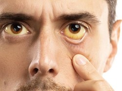 5 Cara Memutihkan Bola Mata yang Kuning Secara Alami