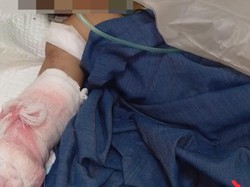 Jari Tangan Balita Bima Terancam Cacat Diduga Berawal dari Jarum Infus