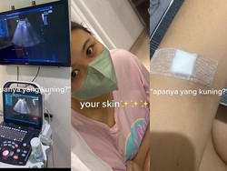 Awal Mula Wanita Tangsel Idap Gangguan Liver di Usia 21, Ini Gejala yang Dikeluhkan