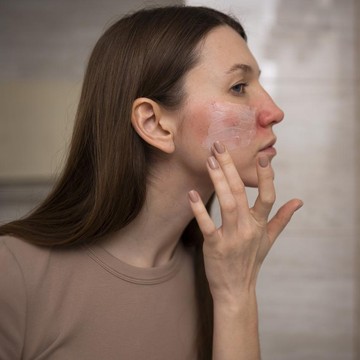 Sering Disalahpahami sebagai Jerawat, Simak Apa Itu Rosacea dan Cara Tepat untuk Mengatasinya