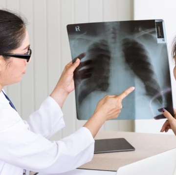 Wajib Tahu! 5 Fakta Kasus TBC di Indonesia yang Jadi Peringkat Ke-2 Terbanyak di Dunia