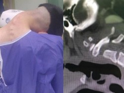 Ngeri! Pemuda Ini Kena Sindrom Kepala Jatuh, Lehernya Melemah dan Bengkok