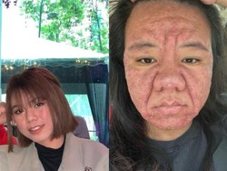 Wanita Malaysia Curhat Wajahnya Berubah saat Hamil, Dermatolog Bilang Gini