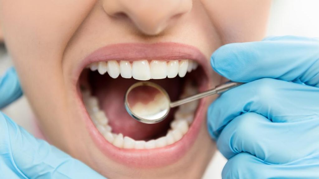 Jenis Perawatan Gigi yang Ditanggung BPJS Kesehatan, Apa Saja?