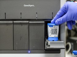 Penjelasan Pakar soal TB Laten, Kasusnya Lagi Meledak di Malaysia