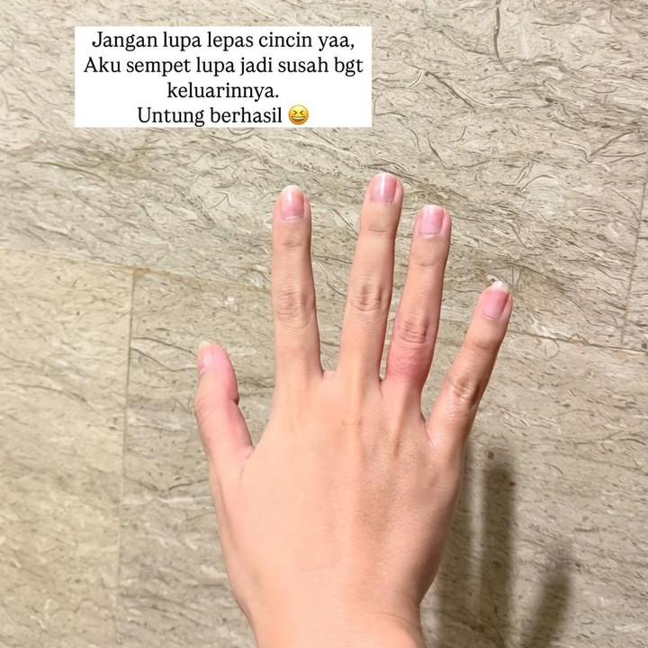 <p>Jelang persalinan, Acha sudah bersiap dengan melepas cincin-cincinnya. Itu agar nanti ketika proses persalinan ia tak kesulitan lagi untuk melepasnya. Foto: Instagram @achasinaga</p>