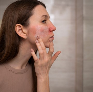 7 Tanda Awal Penyakit Lupus yang Sering Diabaikan, Kamu Wajib Tahu!