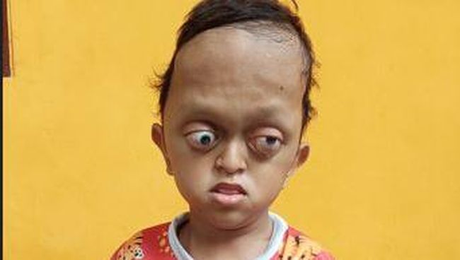 Tabahnya Aufan Derita Hidrosefalus, Crouzon Syndrome hingga Spina Bifida