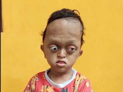 Tabahnya Aufan Derita Hidrosefalus, Crouzon Syndrome hingga Spina Bifida