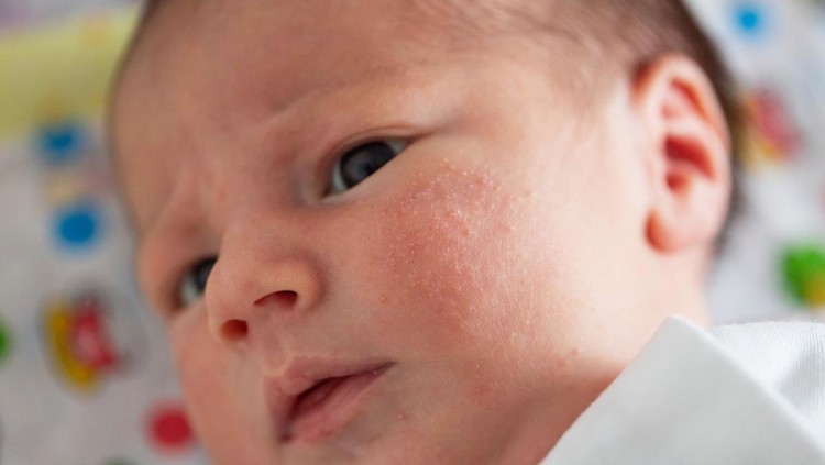 Bintik merah pada bayi