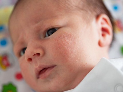 Bintik Merah pada Tubuh Bayi Baru Lahir, Kapan Tanda Perlu ke Dokter?