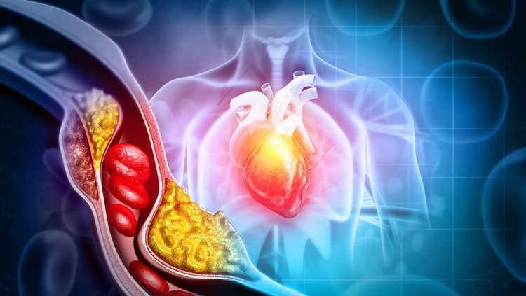 Ilustrasi kolesterol pada tubuh manusia Cholesterol blocked artery with heart. 3d illustration