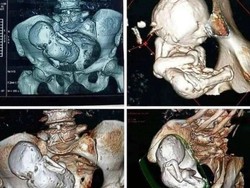 Sederet Kasus Langka Litopedion, Saat Janin Membatu dan Jadi Mumi di Perut