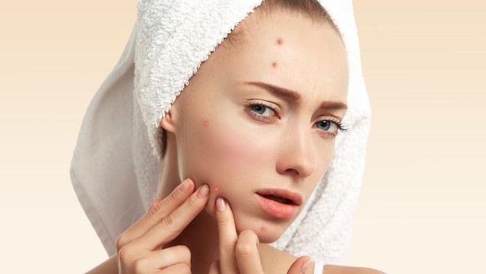 img-title 7 Bahan Alami untuk Mengatasi Jerawat Hormonal