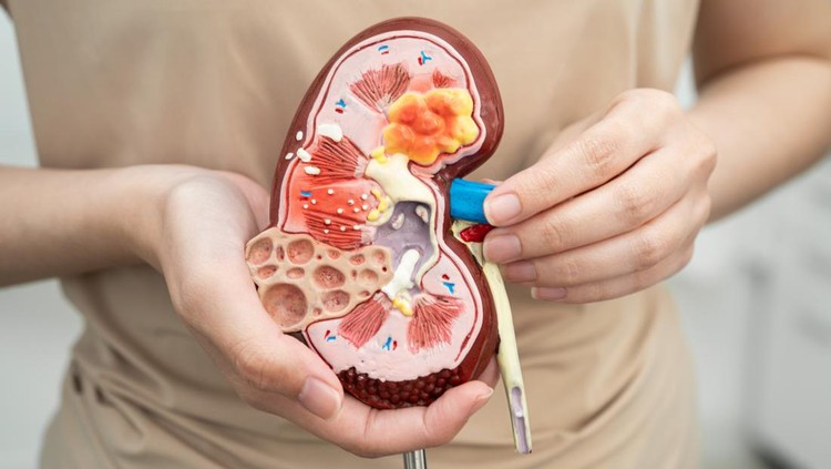 Ilustrasi batu ginjal Chronic kidney disease, Asian woman with model for treatment urinary system, urology, Estimated glomerular filtration rate eGFR.